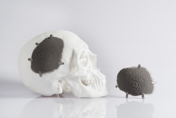 3D Printing And Customised Medical Implants | Protolabs